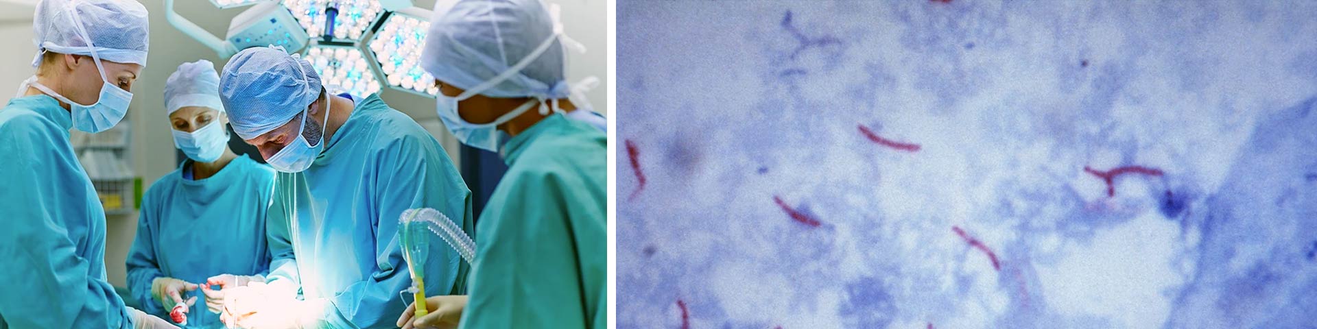 Mycobacterium chimaera and open cardiac surgery