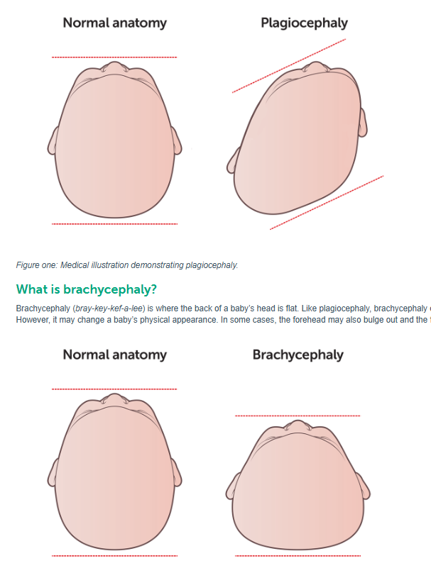 Plagiocephaly and brachycephaly - misshapen head